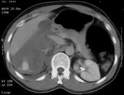 Bleed in Adrenal Bed - CTisus CT Scan