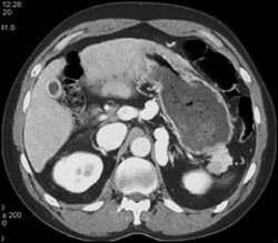 Varix Simulates Adrenal Lesion - CTisus CT Scan