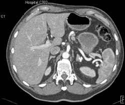 Adrenal Calcification Due to Old Tuberculosis (TB) - CTisus CT Scan