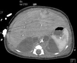 Bilateral Adrenal Hematomas - CTisus CT Scan