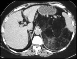 Liposarcoma Simulates Myelolipoma - CTisus CT Scan