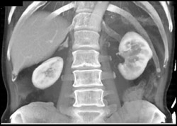 Normal Right Adrenal - CTisus CT Scan