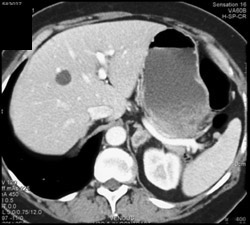 Lung Cancer Metastatic to the Adrenals - CTisus CT Scan