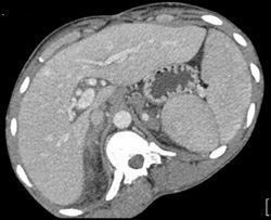 Hemorrhage in Right Adrenal Bed Due to Anticoagulation Therapy - CTisus CT Scan