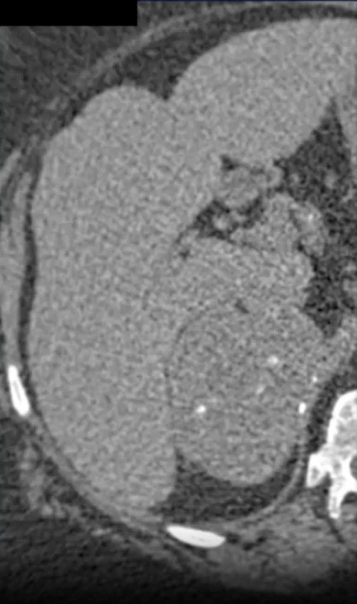 Epithelioid Angiosarcoma - CTisus CT Scan