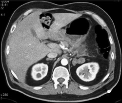 Adrenal Adenomatous Hyperplasia - CTisus CT Scan