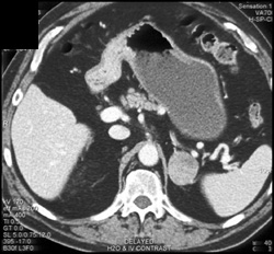 Lung Cancer Metastatic to Adrenal - CTisus CT Scan