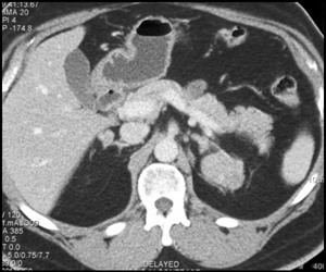 Left Adrenal Metastases - CTisus CT Scan