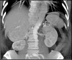 Right Adrenal Carcinoma - CTisus CT Scan