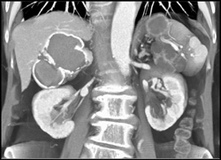 Calcified Right Adrenal Hematoma - CTisus CT Scan
