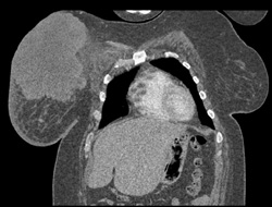 Breast Cancer With Left Adrenal Metastases - CTisus CT Scan