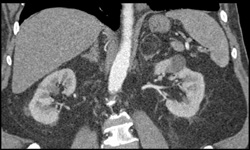 Left Adrenal Myelolipoma - CTisus CT Scan