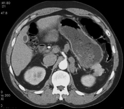 Varices Simulate A Left Adrenal Mass - CTisus CT Scan