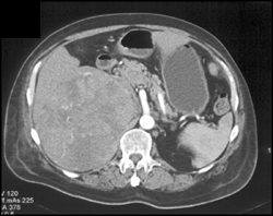Hepatoma - CTisus CT Scan