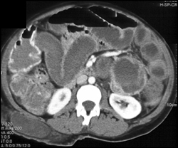 Necrotic Pheochromocytoma - CTisus CT Scan