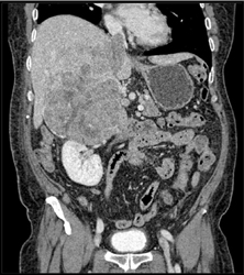 Adrenal Carcinoma Invades the Inferior Vena Cava (IVC) - CTisus CT Scan