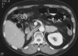 Adrenal Lymphoma - CTisus CT Scan