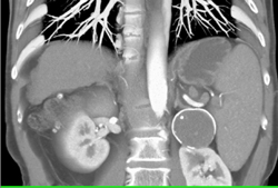 Old Adrenal Hematoma - CTisus CT Scan