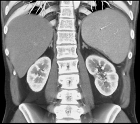 Normal Adrenal Glands - CTisus CT Scan