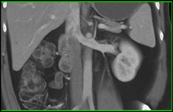Normal Left Adrenal Vein - CTisus CT Scan