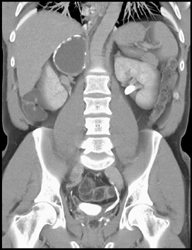 Adrenal Hematoma - CTisus CT Scan