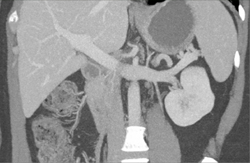 Normal Adrenal Vein - CTisus CT Scan