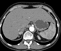 Adrenal Hemangioma - CTisus CT Scan