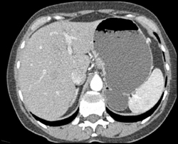 Pseudo-adrenal Lesion Due to Gastric Fundus - CTisus CT Scan