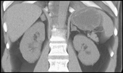 Adrenal Adenomas - CTisus CT Scan