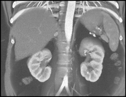 Pheochromocytoma - CTisus CT Scan