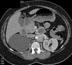 Para-aortic Nodes Due to Adrenal Metastases - CTisus CT Scan