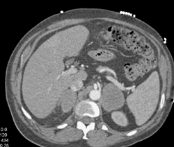 Adrenal Metastases From Lung Cancer - CTisus CT Scan