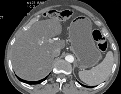 Adrenal Pseudolesion-stomach - CTisus CT Scan