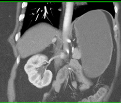1 Cm Pheochromocytoma - CTisus CT Scan