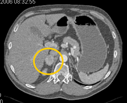 Metastatic Renal Cell Carcinoma to the Adrenal Gland - CTisus CT Scan