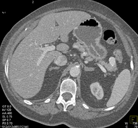 Adrenal Hyperplasia - CTisus CT Scan