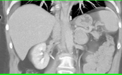 Metastatic Lung Cancer-left Adrenal - CTisus CT Scan