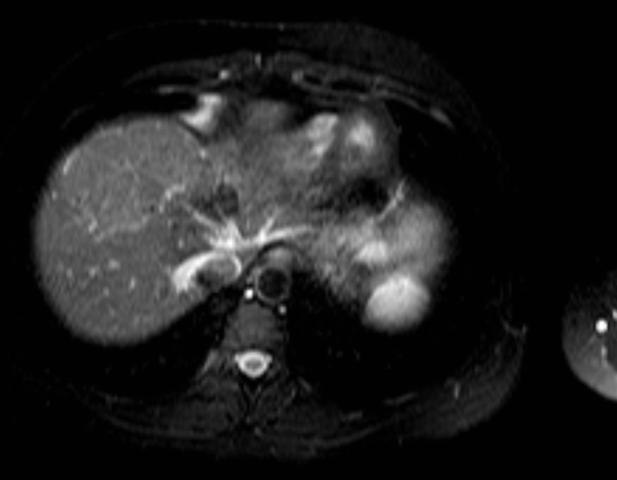 Focal nodular hyperplasia - CTisus CT Scan