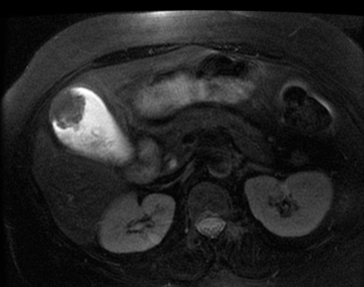 Gallbladder cancer. - CTisus CT Scan