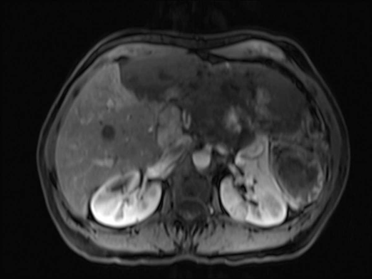 Giant hemangioma - CTisus CT Scan