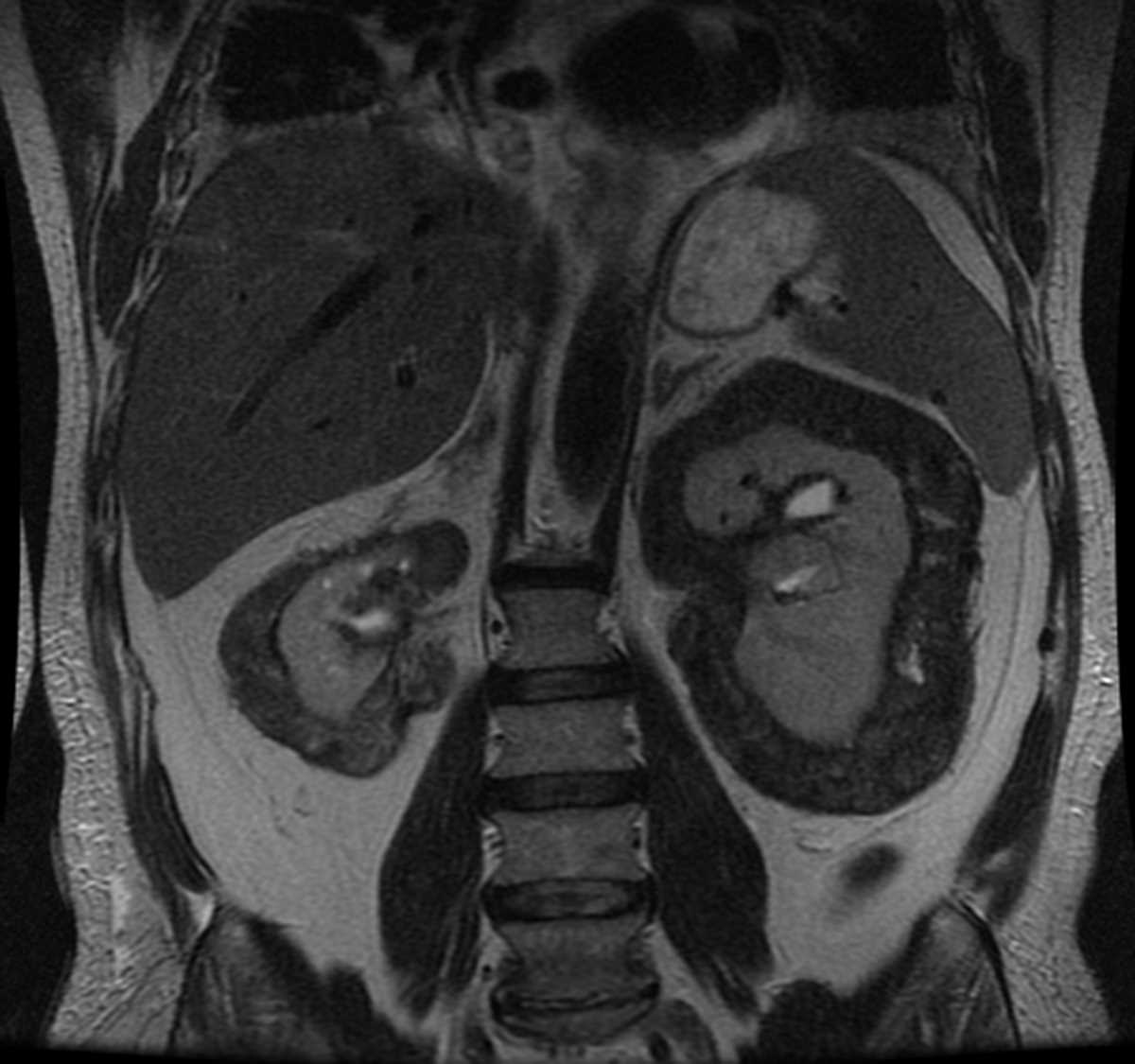 Erdheim Chester Disease - CTisus CT Scan