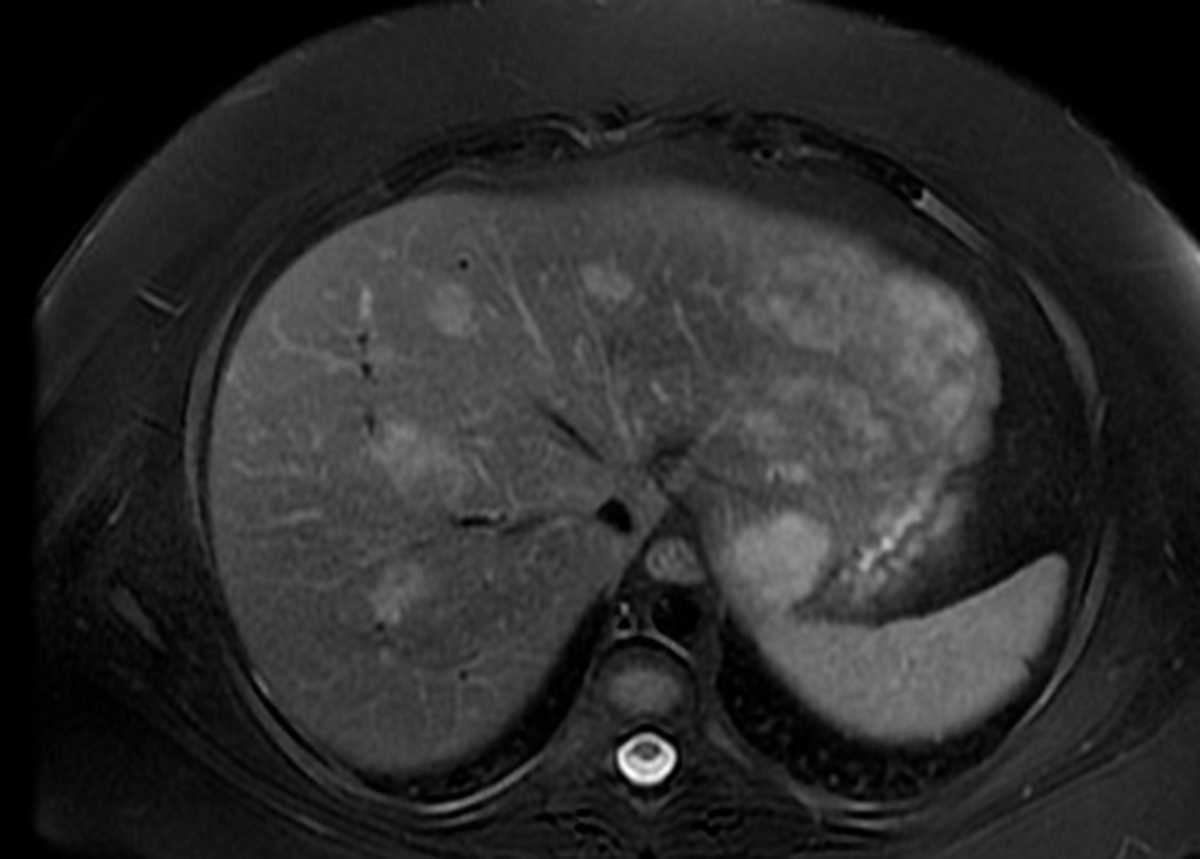 Hepatic adenomatosis - CTisus CT Scan