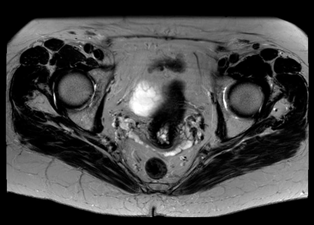 Tamoxifen associated endometrial hyperplasia - CTisus CT Scan