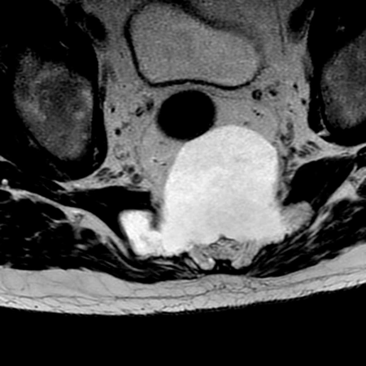 Sacral Chordoma - CTisus CT Scan