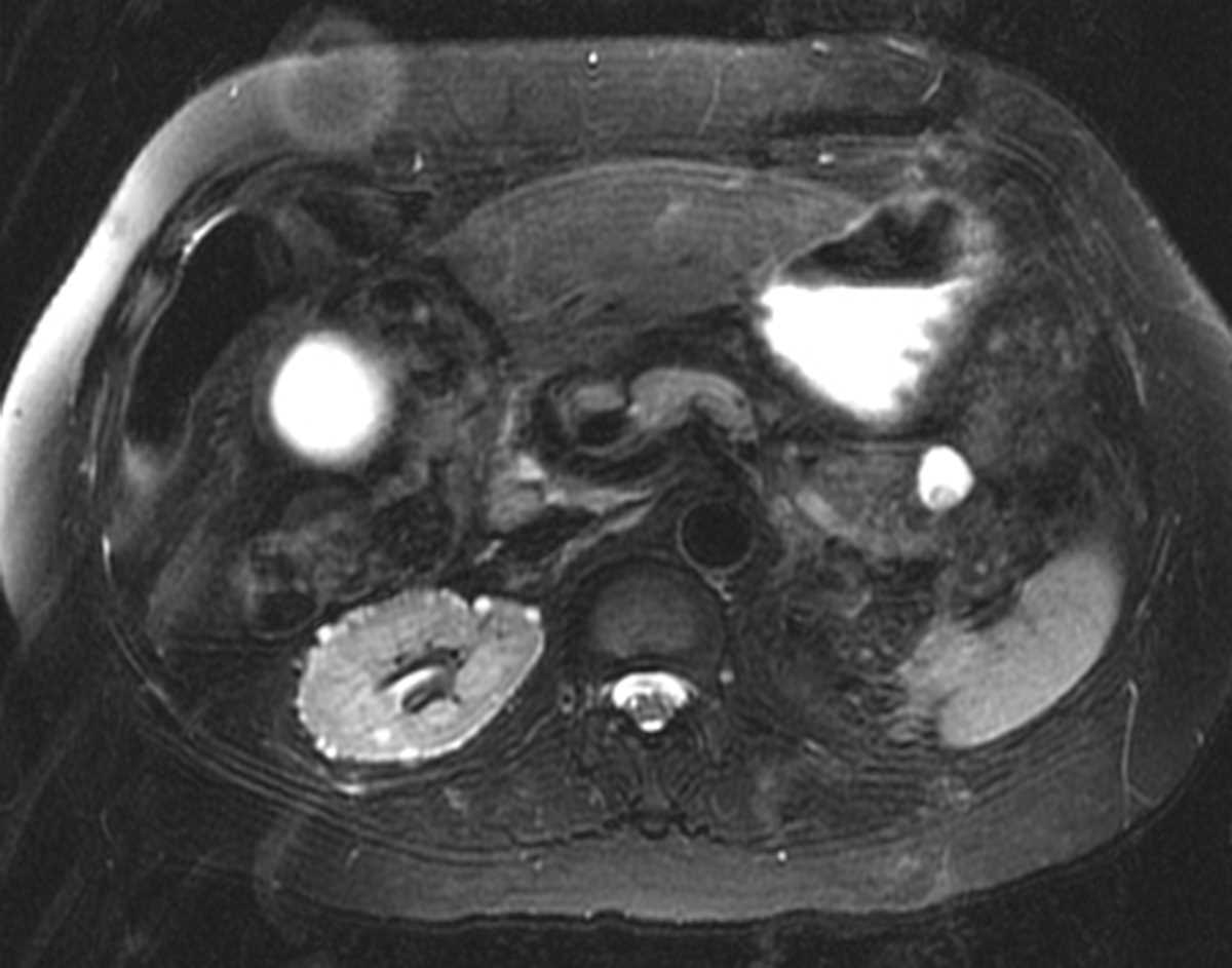 Lithium Nephropathy - CTisus CT Scan