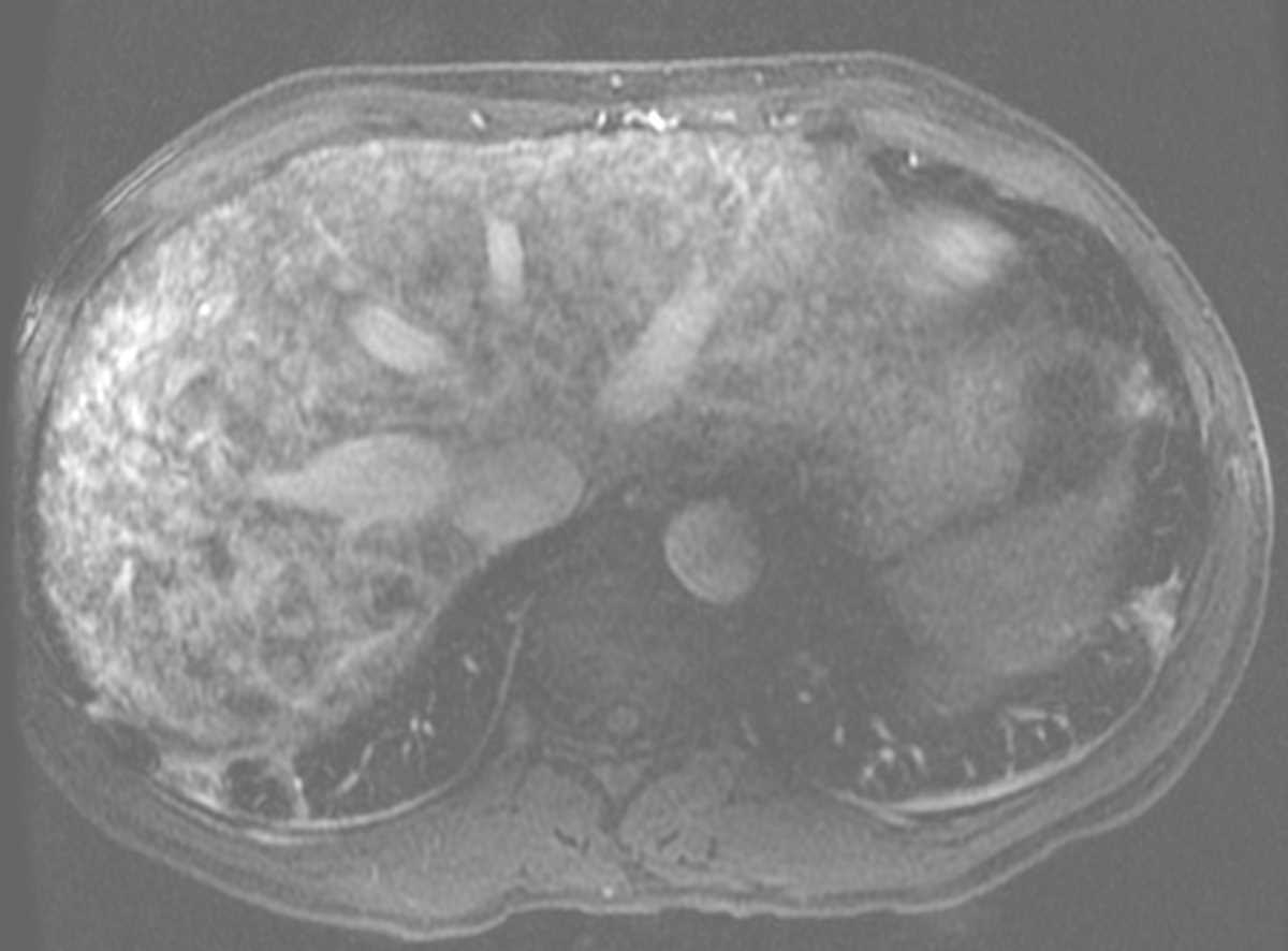 Hereditary Hemorrhagic Telangiectasia of the Liver - CTisus CT Scan