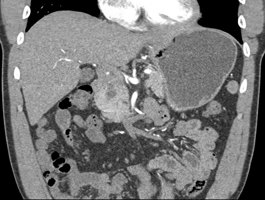 Choledochal Cyst off Common Bile Duct - CTisus CT Scan