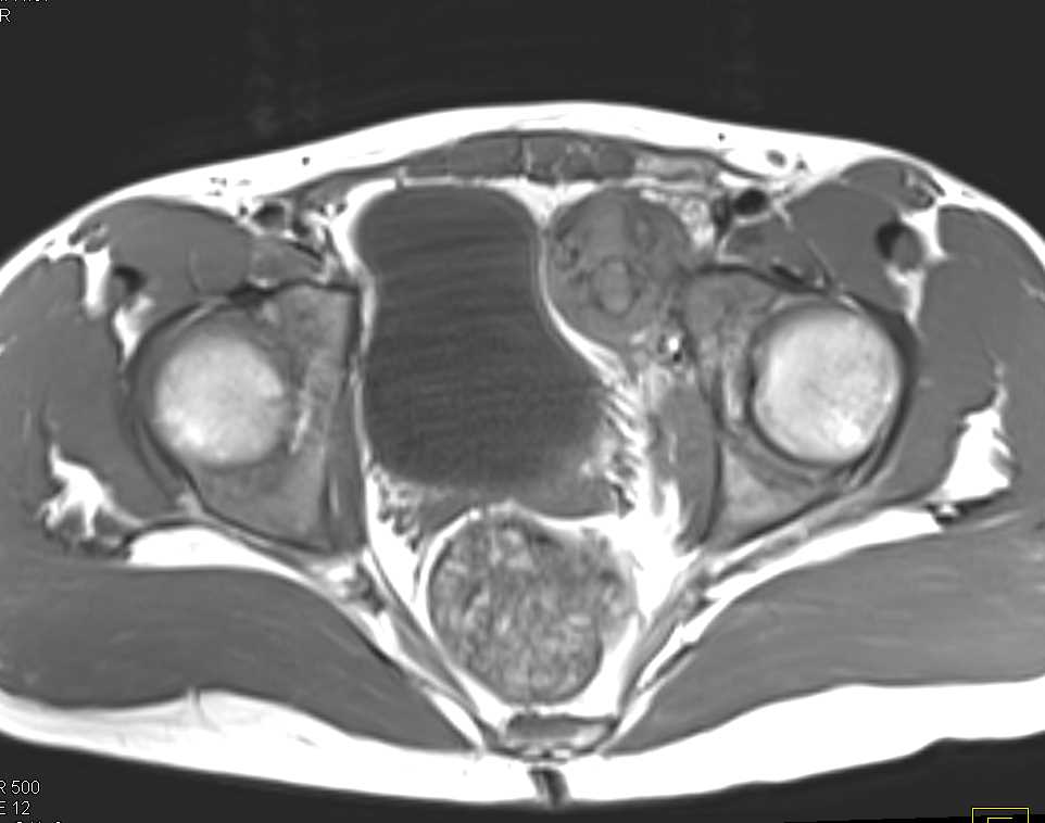 Ewing Sarcoma Pelvis - CTisus CT Scan
