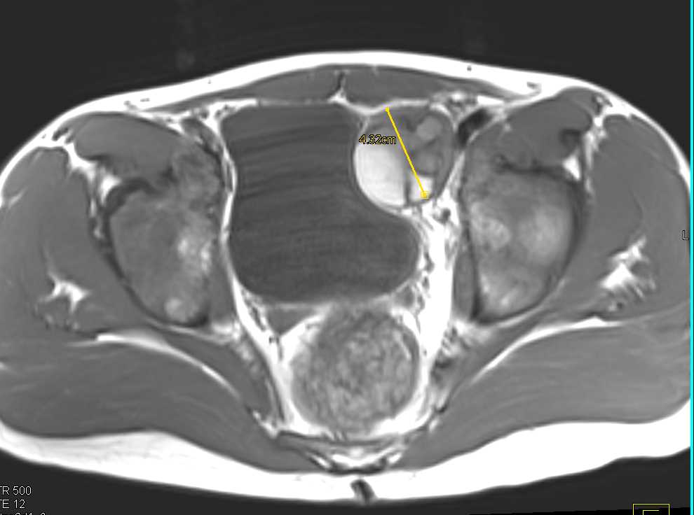 Ewing Sarcoma Pelvis - CTisus CT Scan