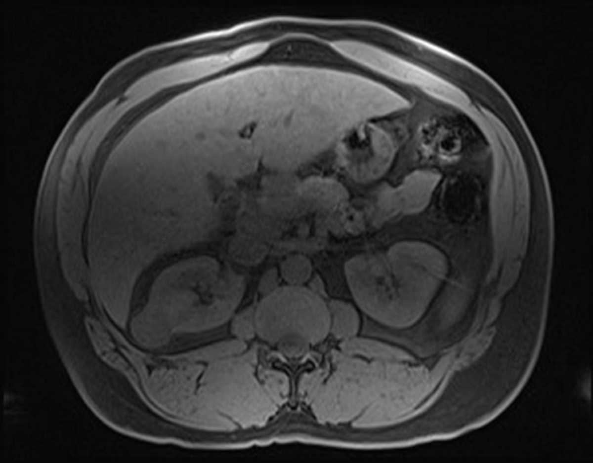 Papillary renal cell carcinoma - CTisus CT Scan